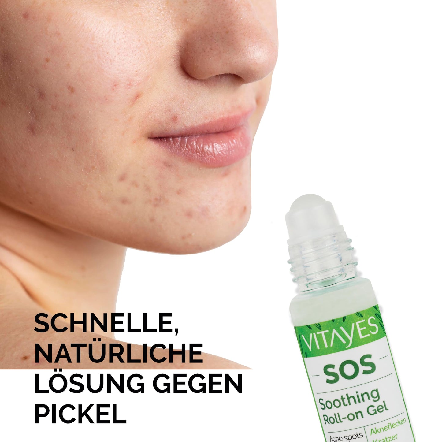 Vitayes SOS BIO Teebaumöl Roller, Ätherisches Öl gegen Pickel, Akne, Hautentzündungen, beruhigender Roll-on Stift, Pickel, unreine Haut, Vegan, gegen Hautrötungen, 3x 10ml